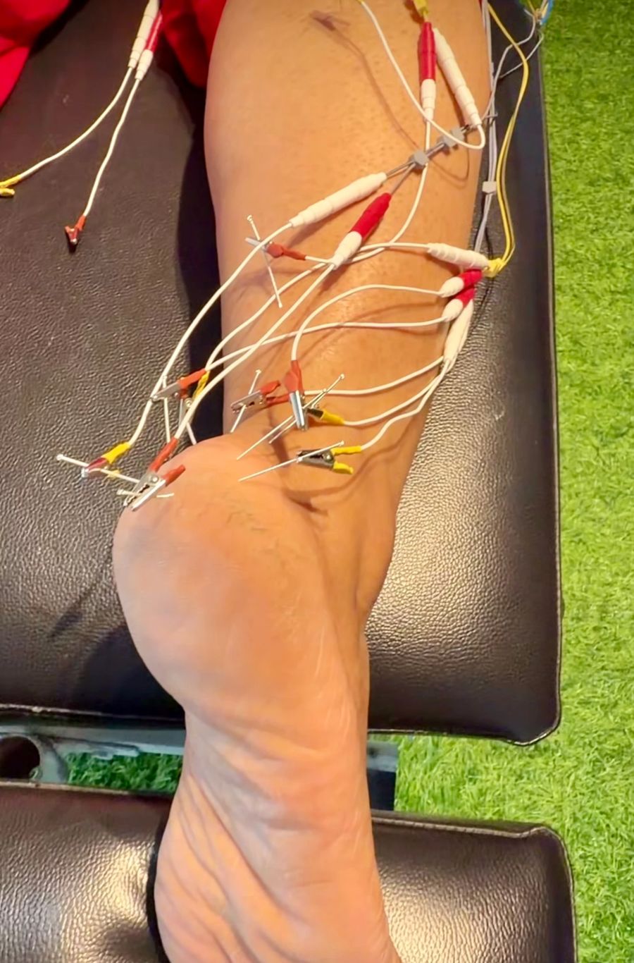 Dry needling with electrical stimulation on a patient's calf and heel at Dr. Kailash Physiotherapy Clinic, Dehradun